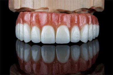 オールオン4で作った仮歯を調整して2最終の歯を作ります